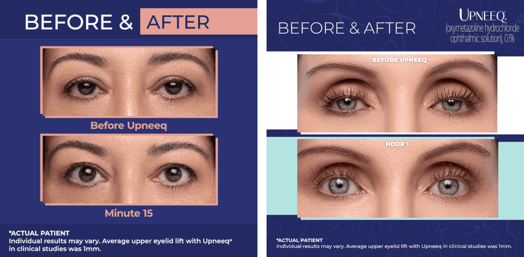 Before and after pictures of droopy eyelids treated with Upneeq after 15 minutes and 1 hour