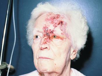 Elderly woman with red scabs and blisters on the left side of her face