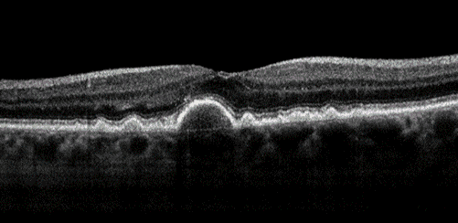 Black and white OCT of dry macular degeneration