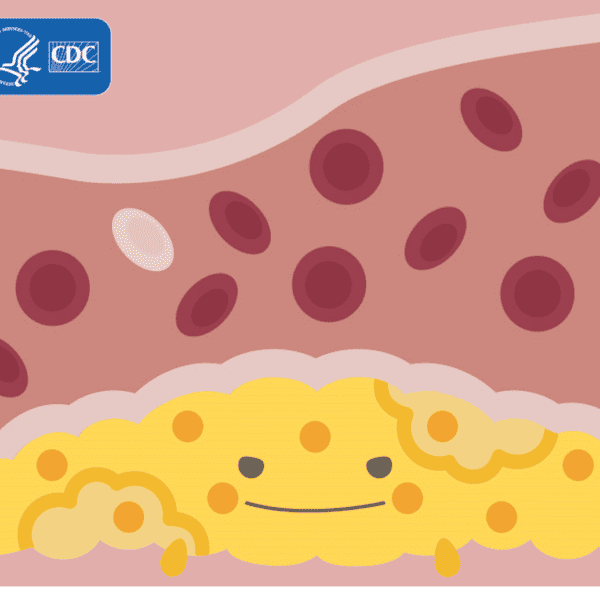 Cartoon of a blood vessel with yellow plaque