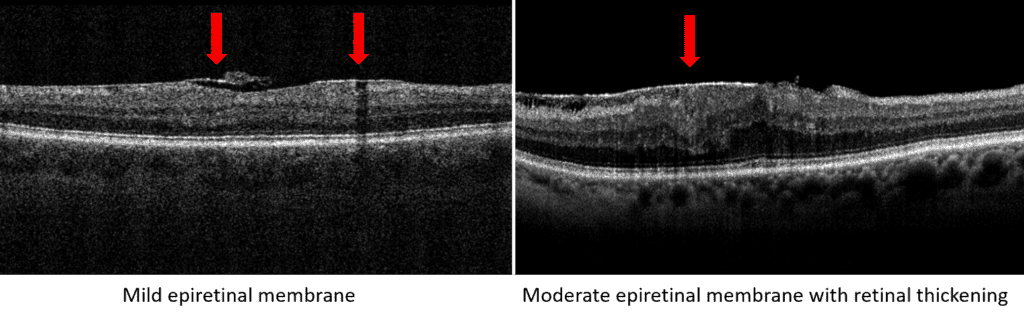 Black and white OCT scan of epiretinal membrane
