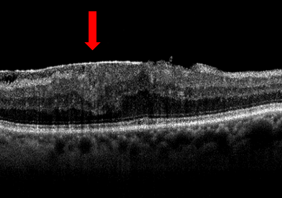 OCT scan of epiretinal membrane with red arrow
