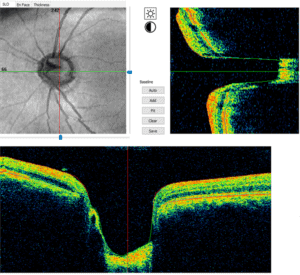 Colored and black and white version of optic nerve OCT scan of glaucoma