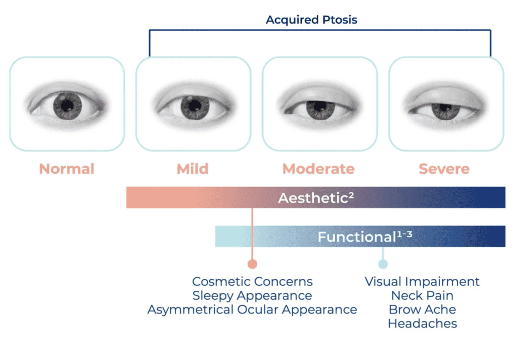 Scale of droopy eyelids