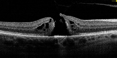 Black and white OCT scan of a full-thickness macular hole