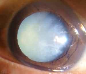 Mature white cataract