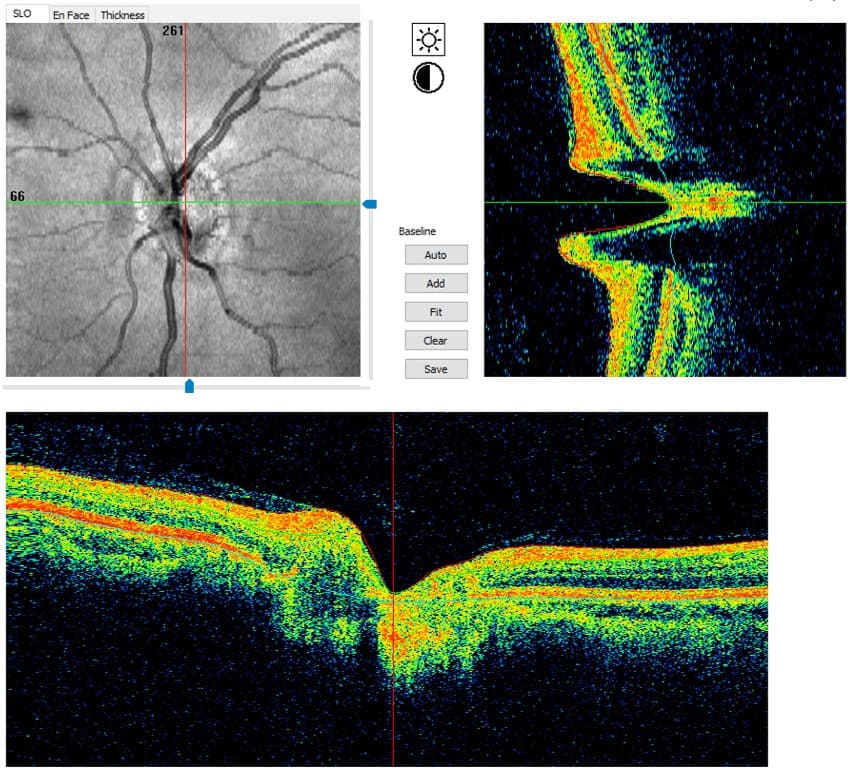 Colored and black and white version of optic nerve OCT scan of normal eye