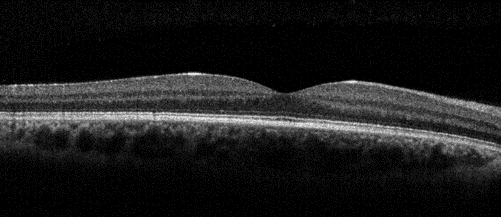 Black and white OCT iWellness scan of a normal macula