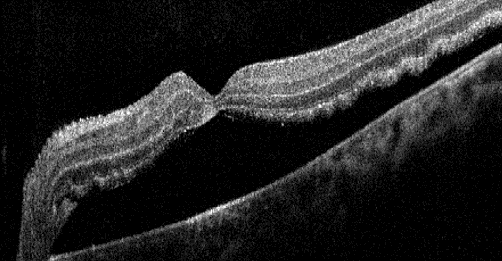 Black and white macular OCT of a patient with a retinal detachment