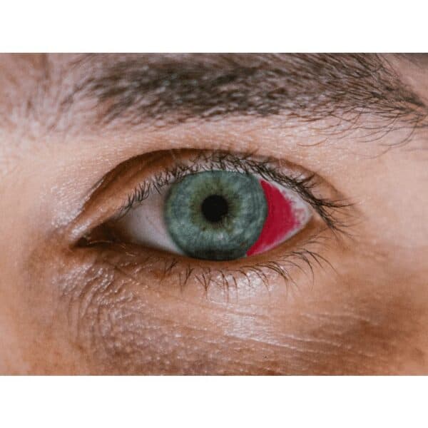 Picture of an eye with blood on top of the white sclera
