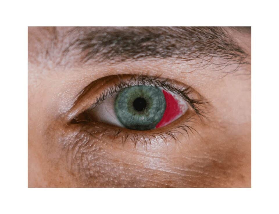 Picture of an eye with blood on top of the white sclera