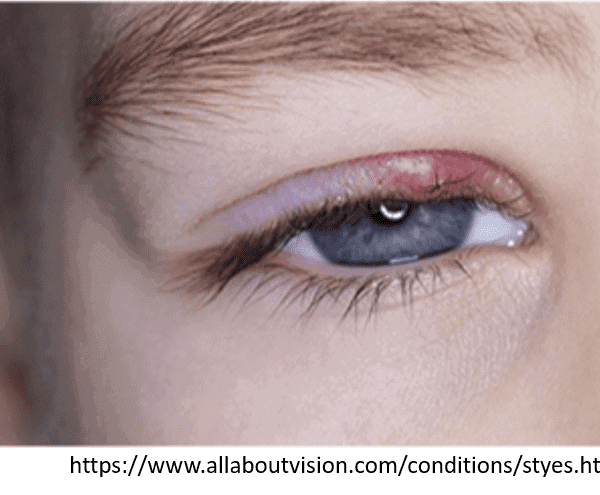 Boy's eyelid with red bump