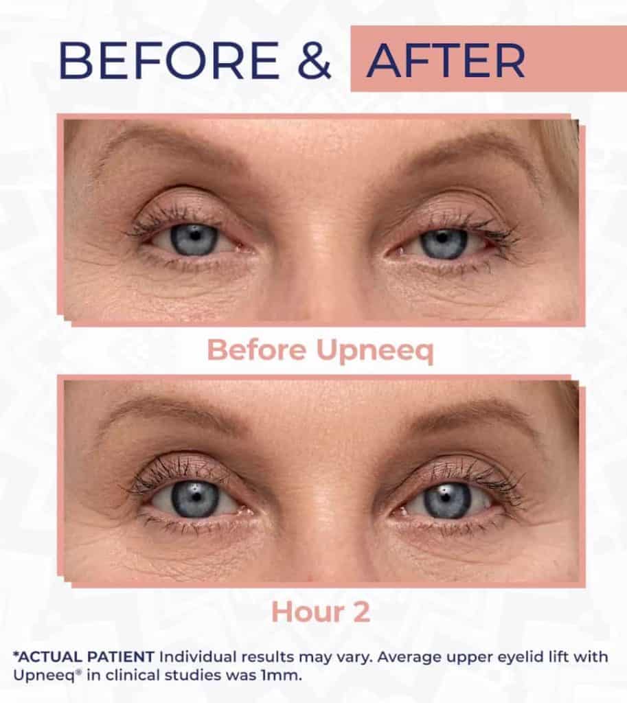 Before and after pictures of droopy eyelids treated with Upneeq after 2 hours