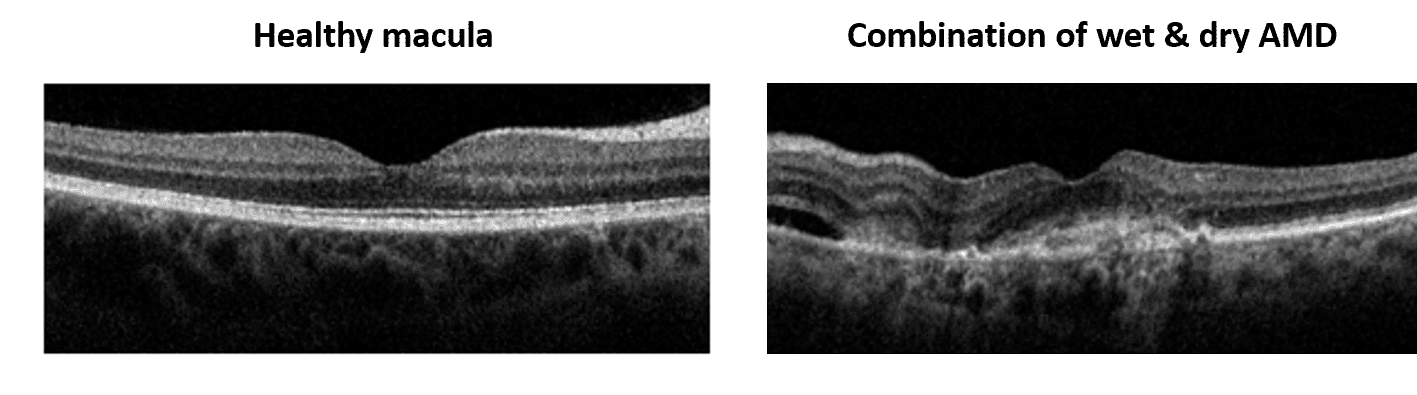 OCT macula scans of healthy retina and macular degeneration retina
