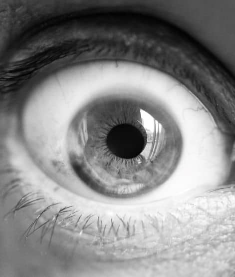 Black and white picture of bulging eye