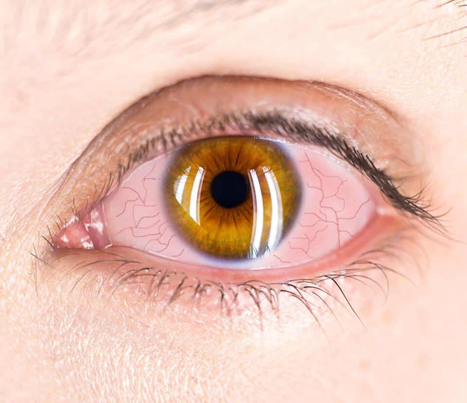 Woman's eye with redness and enlarged conjunctival blood vessels